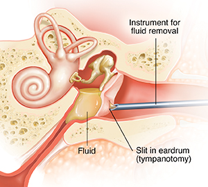 Cross section of child's ear showing fluid in middle ear and slit in the eardrum (tympanotomy). Instrument is suctioning fluid from inner ear.