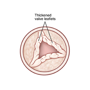 Top view of open aortic valve with thickened leaflets.