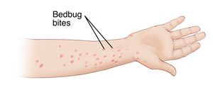 Forearm showing bedbug bites.