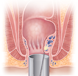 Cross section of anus showing needle releasing medicine into hemorrhoid.