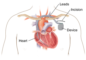 Outline of man's chest showing biventricular implantable cardioverter defibrillator in chest with 3 leads going into heart chambers.