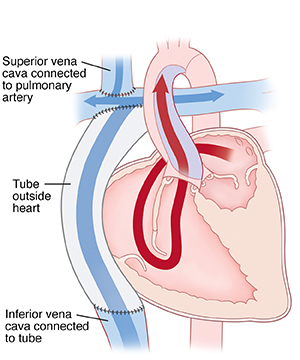 Cross section of heart showing Fontan procedure for hypoplastic left ventricle. Superior vena cava is connected to pulmonary artery. Tube outside heart is connected to inferior vena cava at bottom and superior vena cava at top. Arrows show blood flowing from left atrium to right ventricle, then being pumped out aorta.